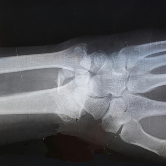 XRAY OF AN ARM